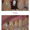 implantologia dentale (1) - Dott. Massimo Pomo